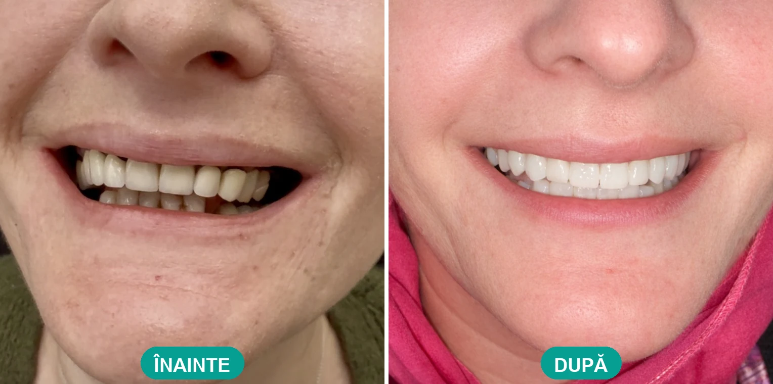 Caz tratat la Cris Smile Studio București – reabilitare orală cu implanturi, înainte și după