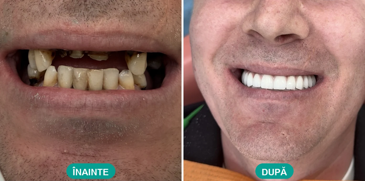 Caz tratat la Cris Smile Studio București – reabilitare orală cu implanturi, înainte și după