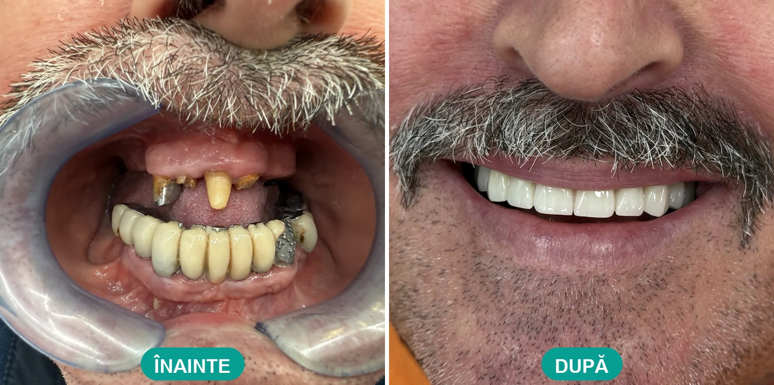 Caz tratat la Cris Smile Studio București – reabilitare orală cu implanturi, înainte și după