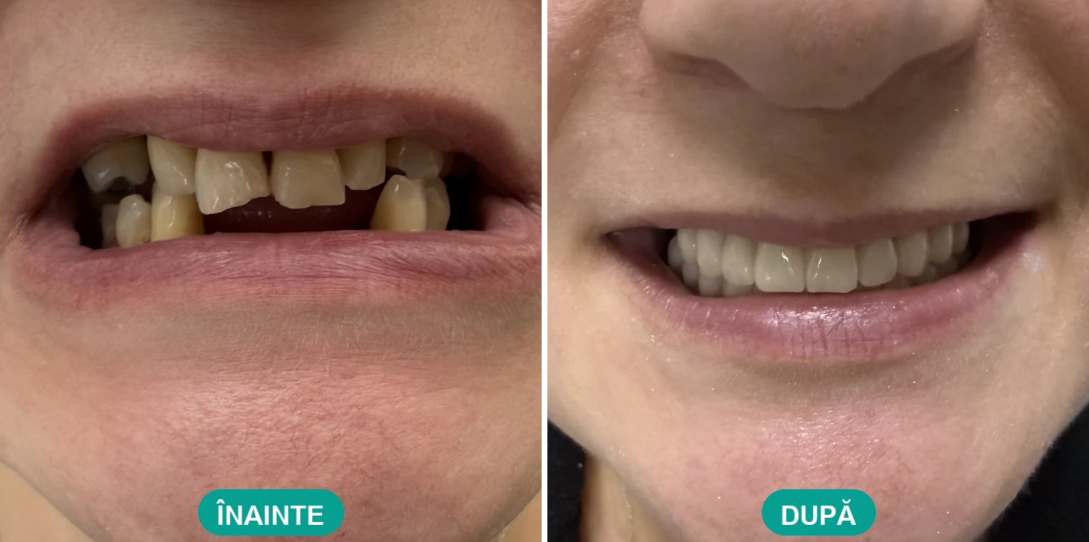 Caz tratat la Cris Smile Studio București – reabilitare orală cu implanturi, înainte și după