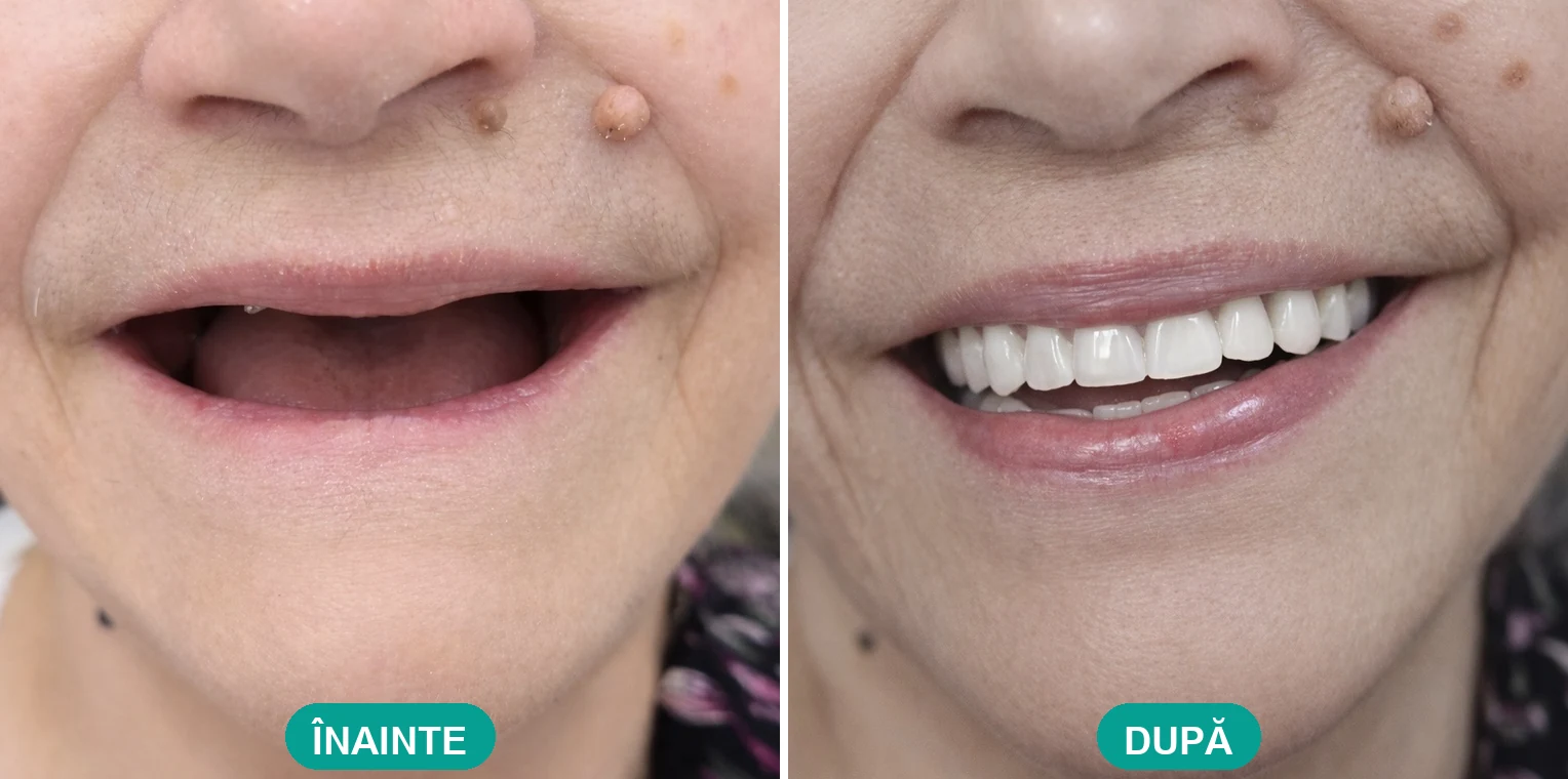 Caz tratat la Cris Smile Studio București – reabilitare orală cu implanturi, înainte și după