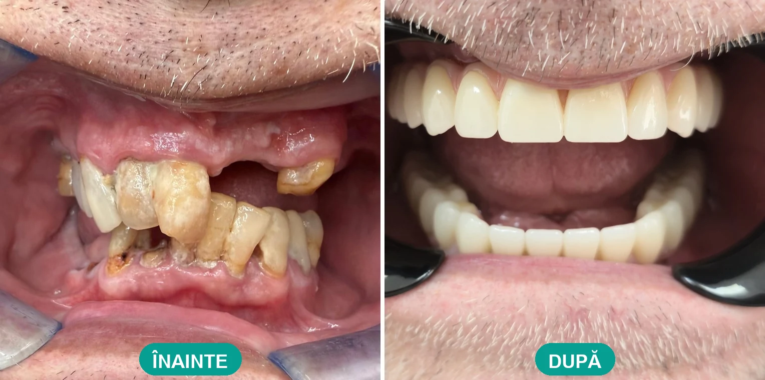 Caz tratat la Cris Smile Studio București – reabilitare orală cu implanturi, înainte și după