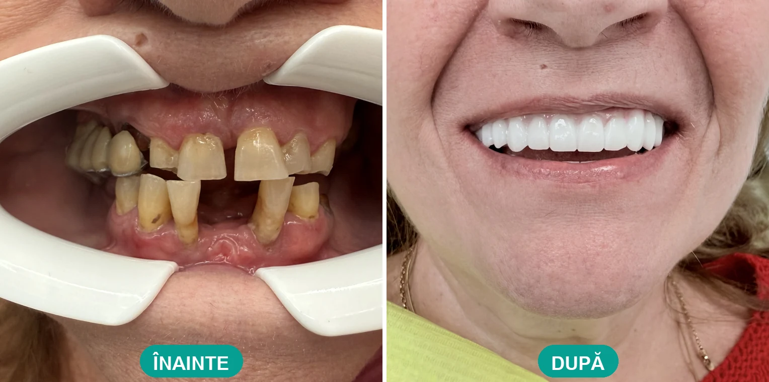 Caz tratat la Cris Smile Studio București – reabilitare orală cu implanturi, înainte și după