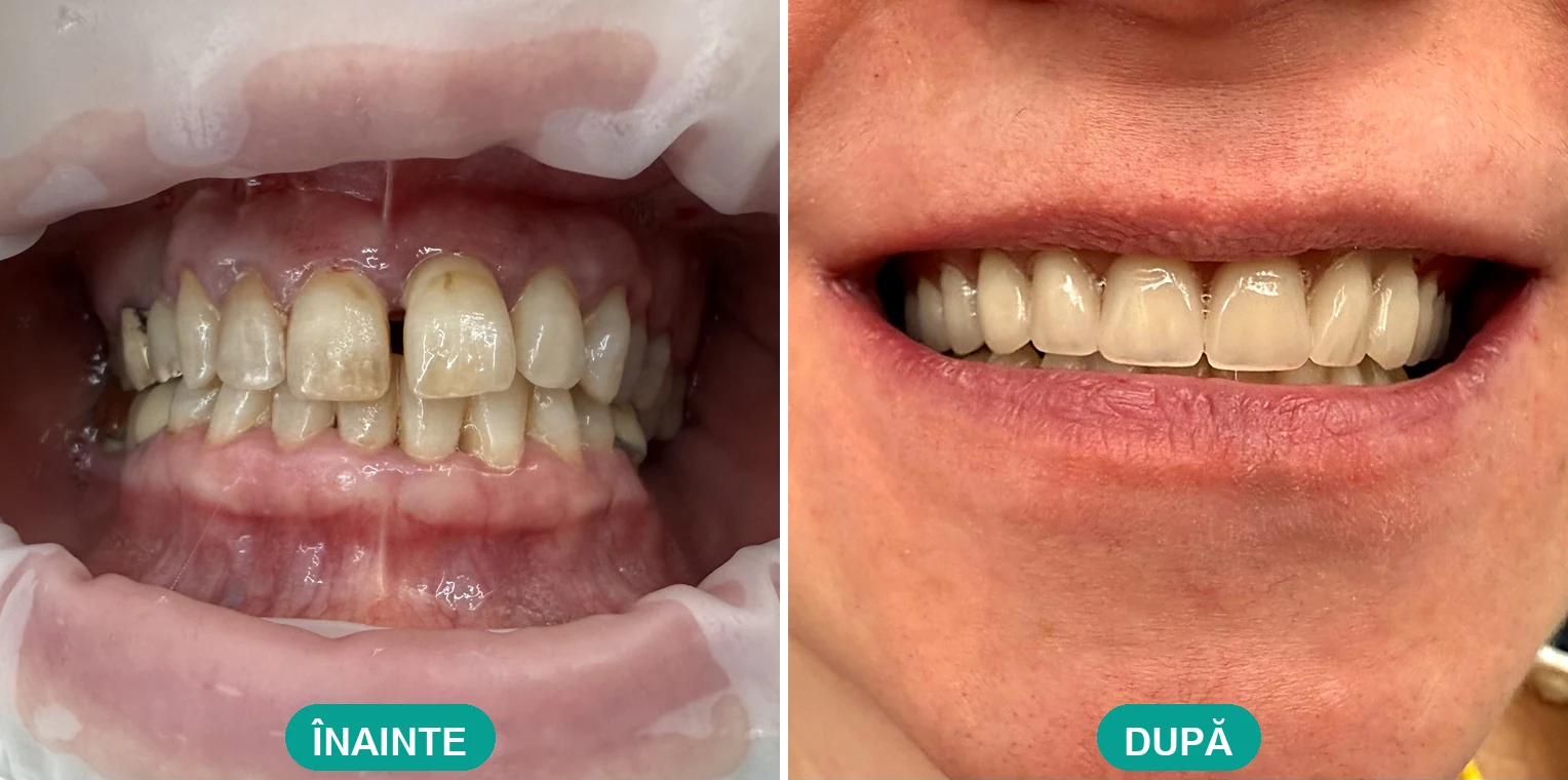 Caz tratat la Cris Smile Studio București – reabilitare orală cu implanturi, înainte și după