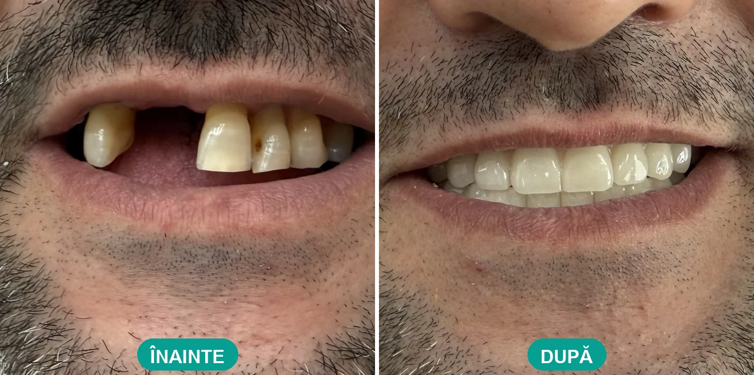 Caz tratat la Cris Smile Studio București – reabilitare orală cu implanturi, înainte și după