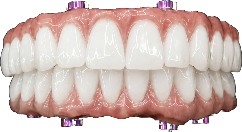 Lucrare dentară completă pe implanturi – reabilitare orală la Cris Smile Studio București